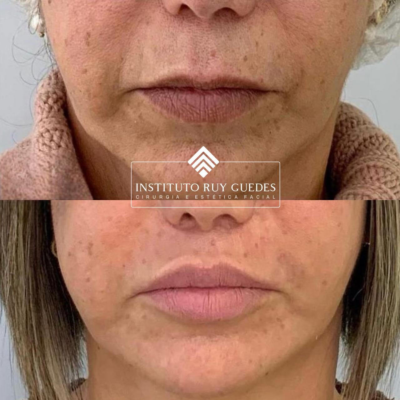 lip-lift-em-porto-alegre-antes-e-depois-01