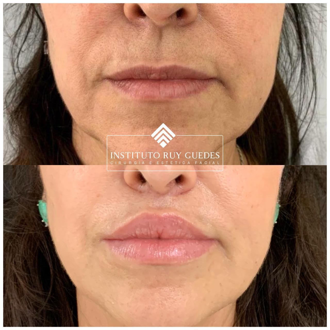 lip-lift-em-porto-alegre-antes-e-depois-02