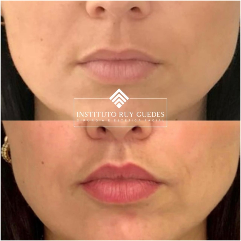 Resultados reais: casos de antes e depois do Lip Lift no consultório do Dr. Ruy Guedes