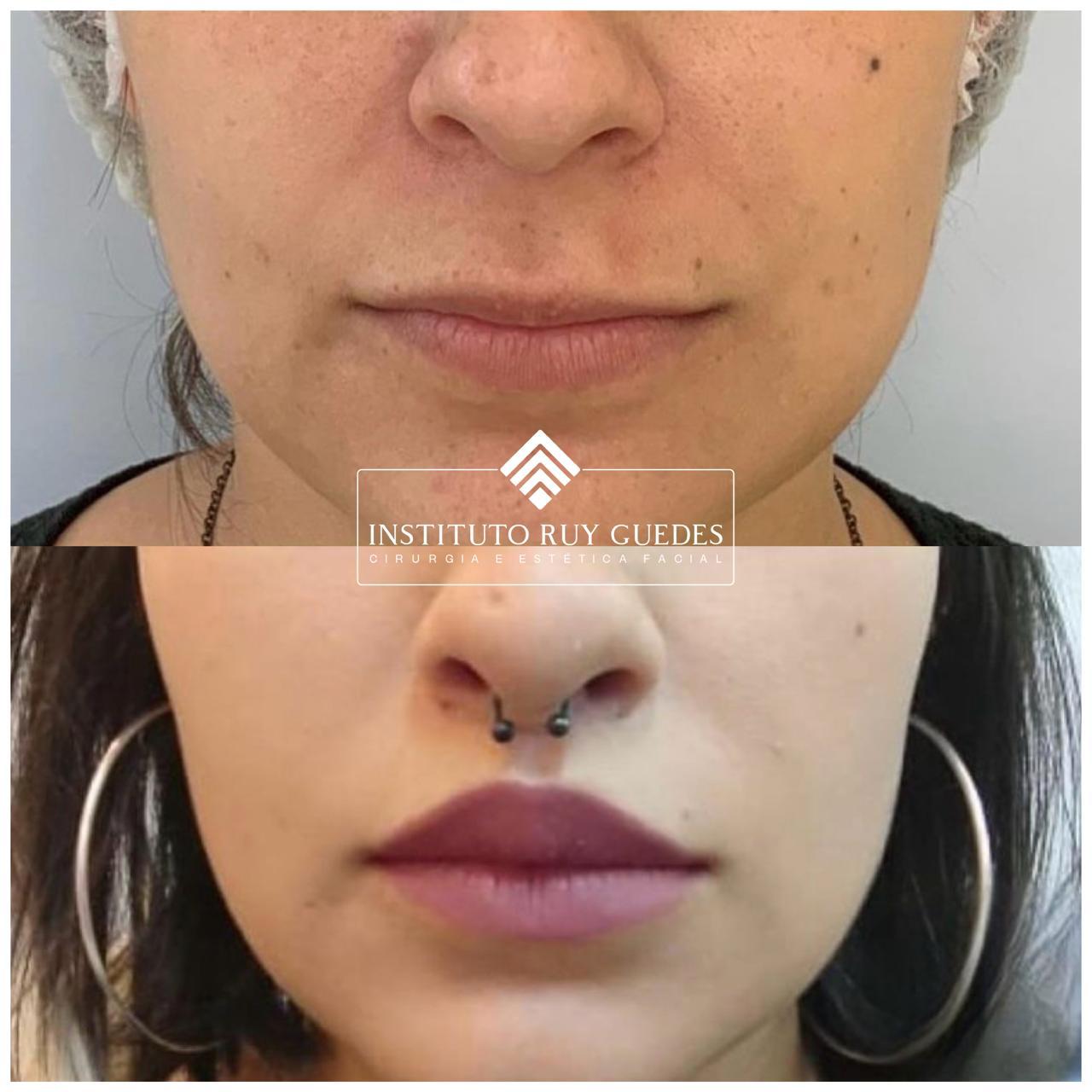 lip-lift-em-porto-alegre-antes-e-depois-04